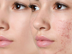 Remove Acne with YOLO